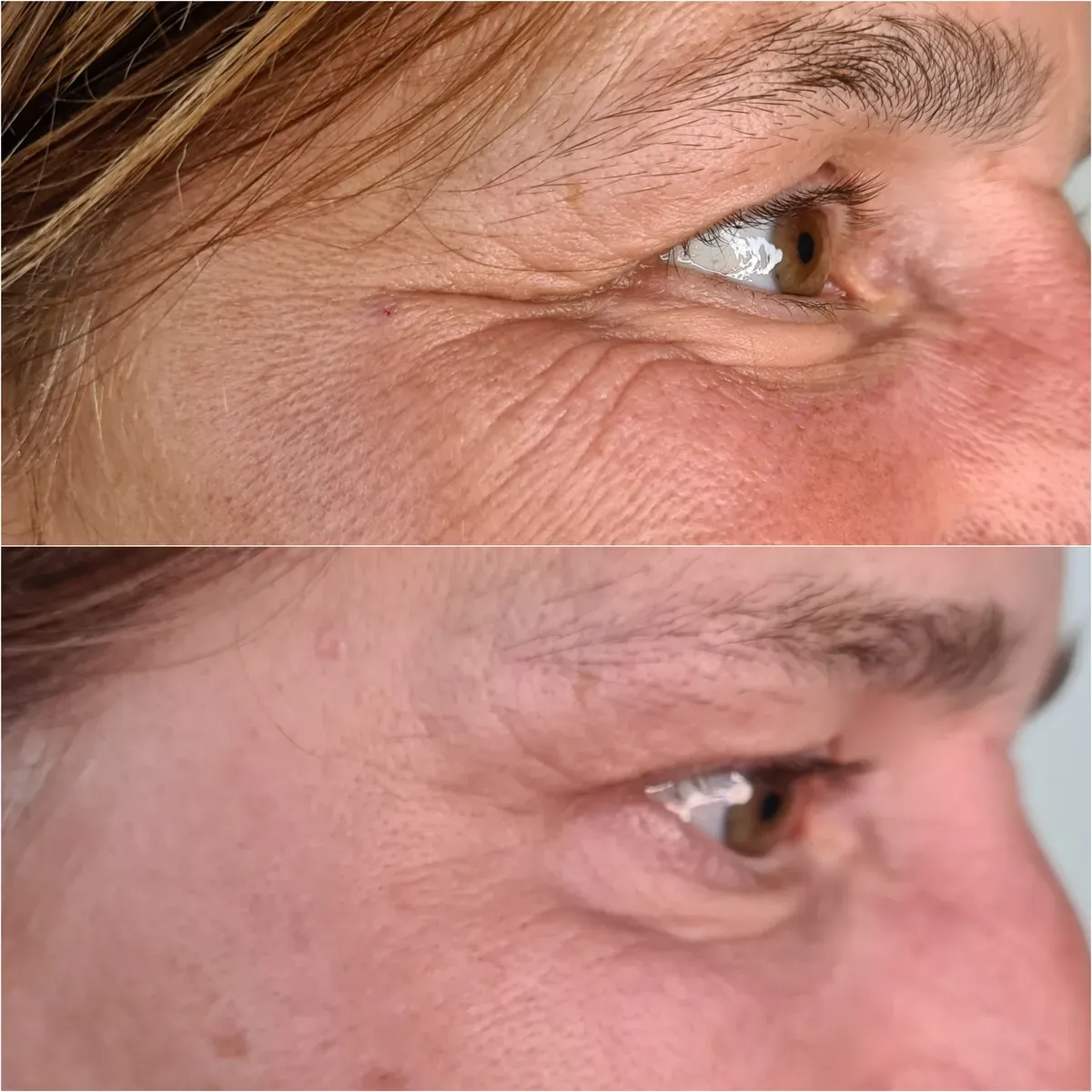 Botulin toksin - prije i poslije