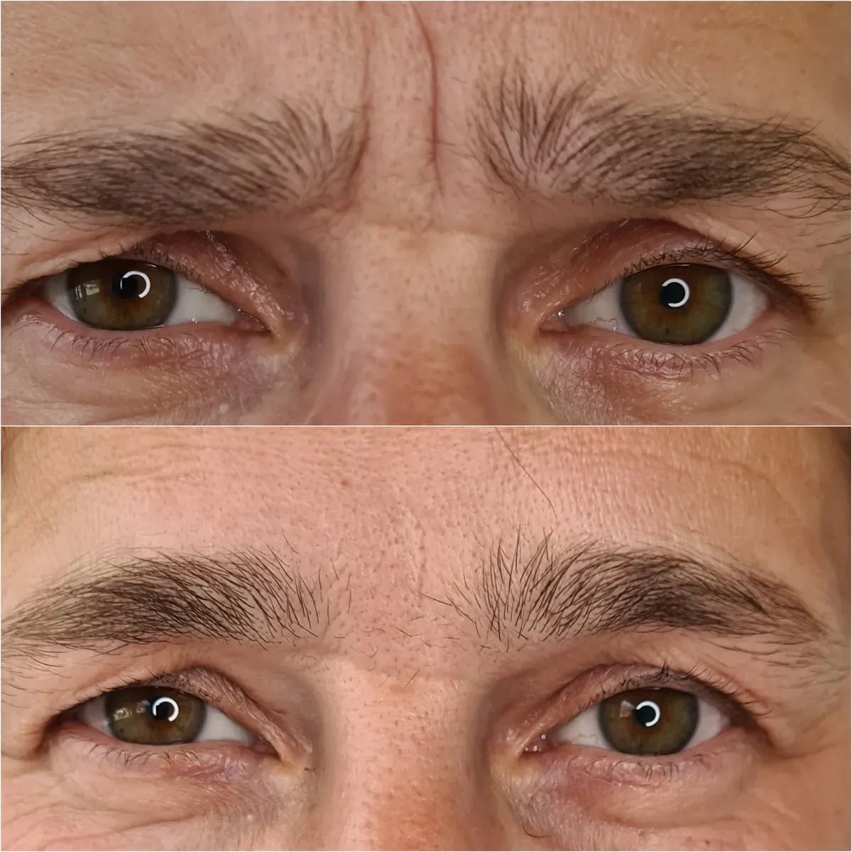 Botulin toksin - prije i poslije