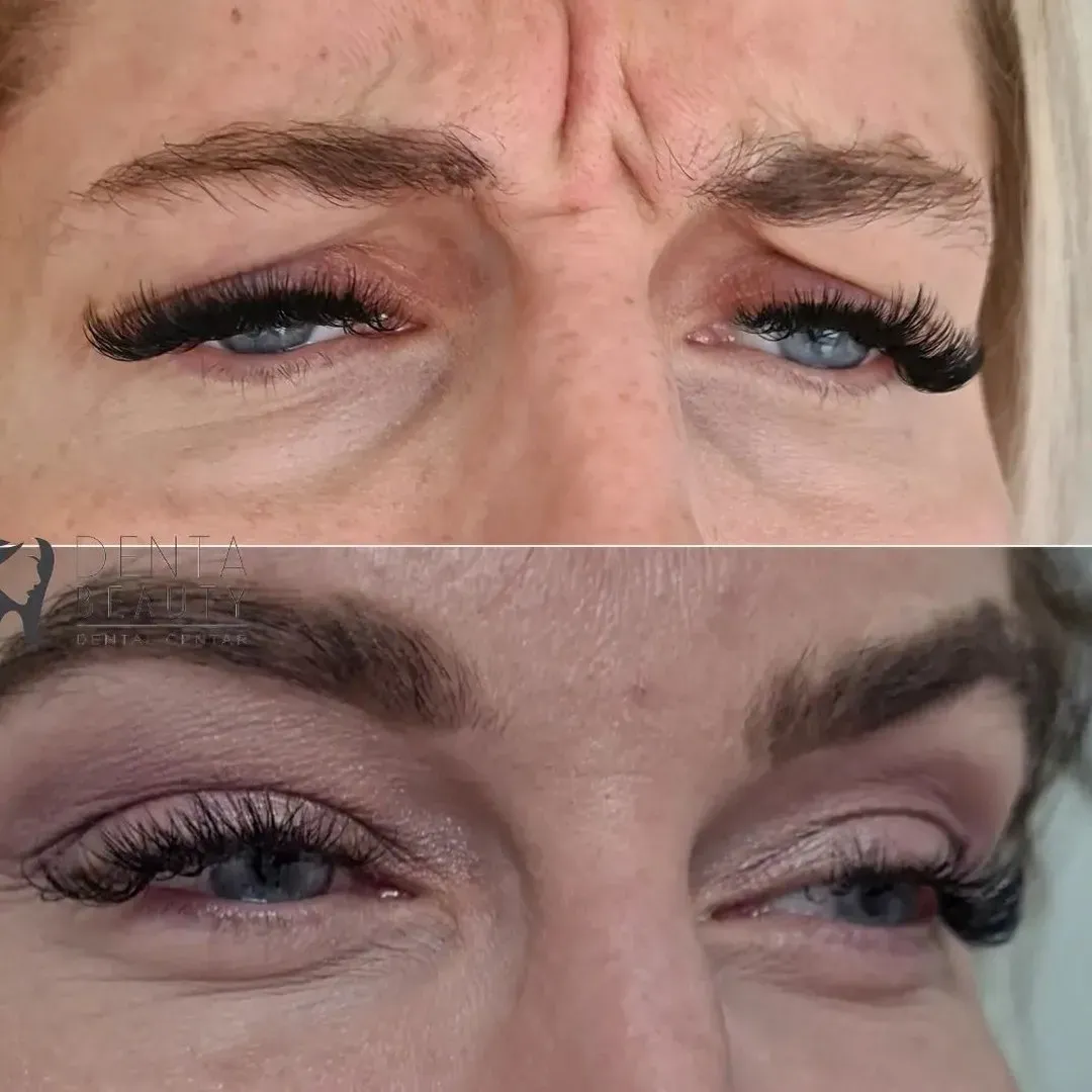 Botulin toksin - prije i poslije