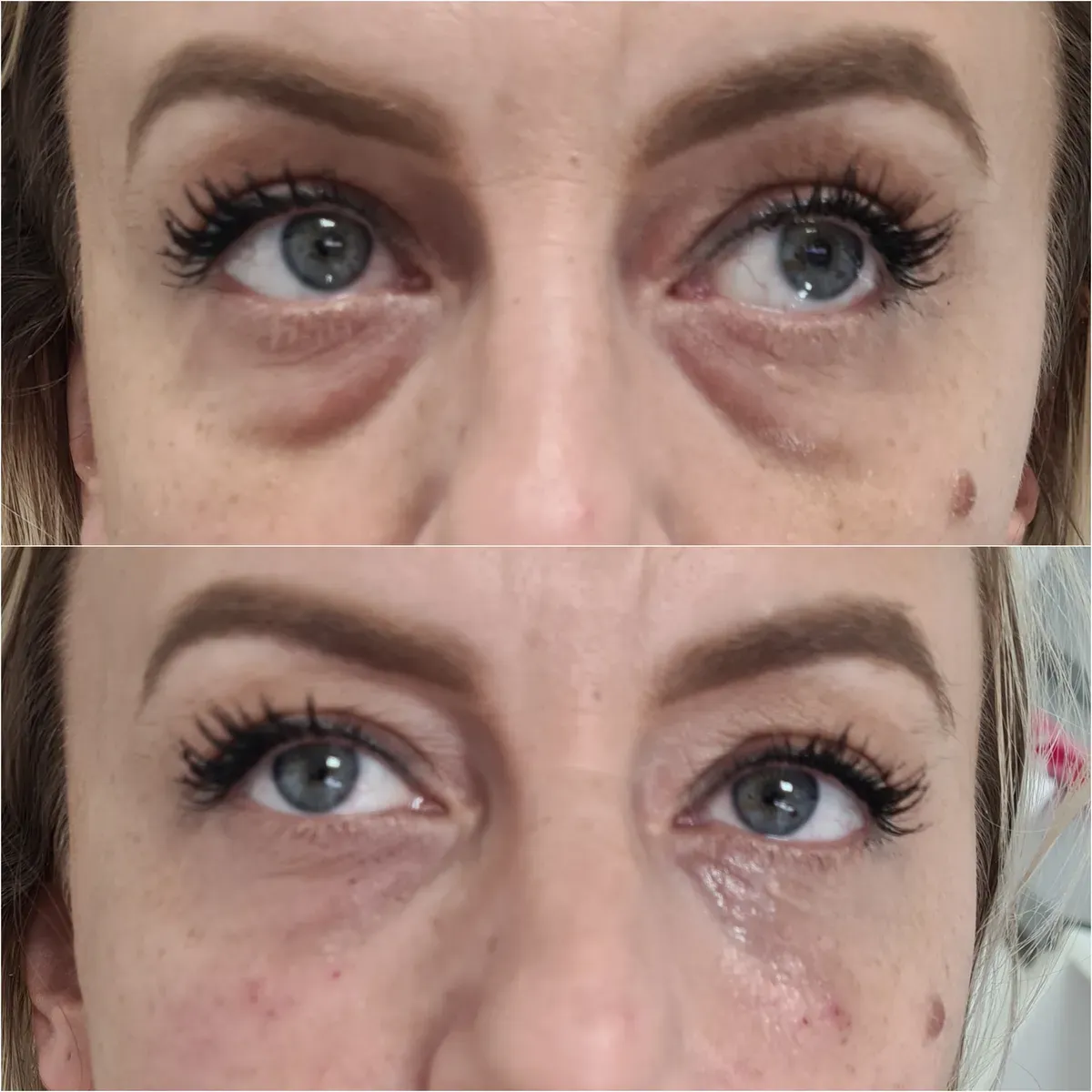 Hijaluronski fileri - prije i poslije