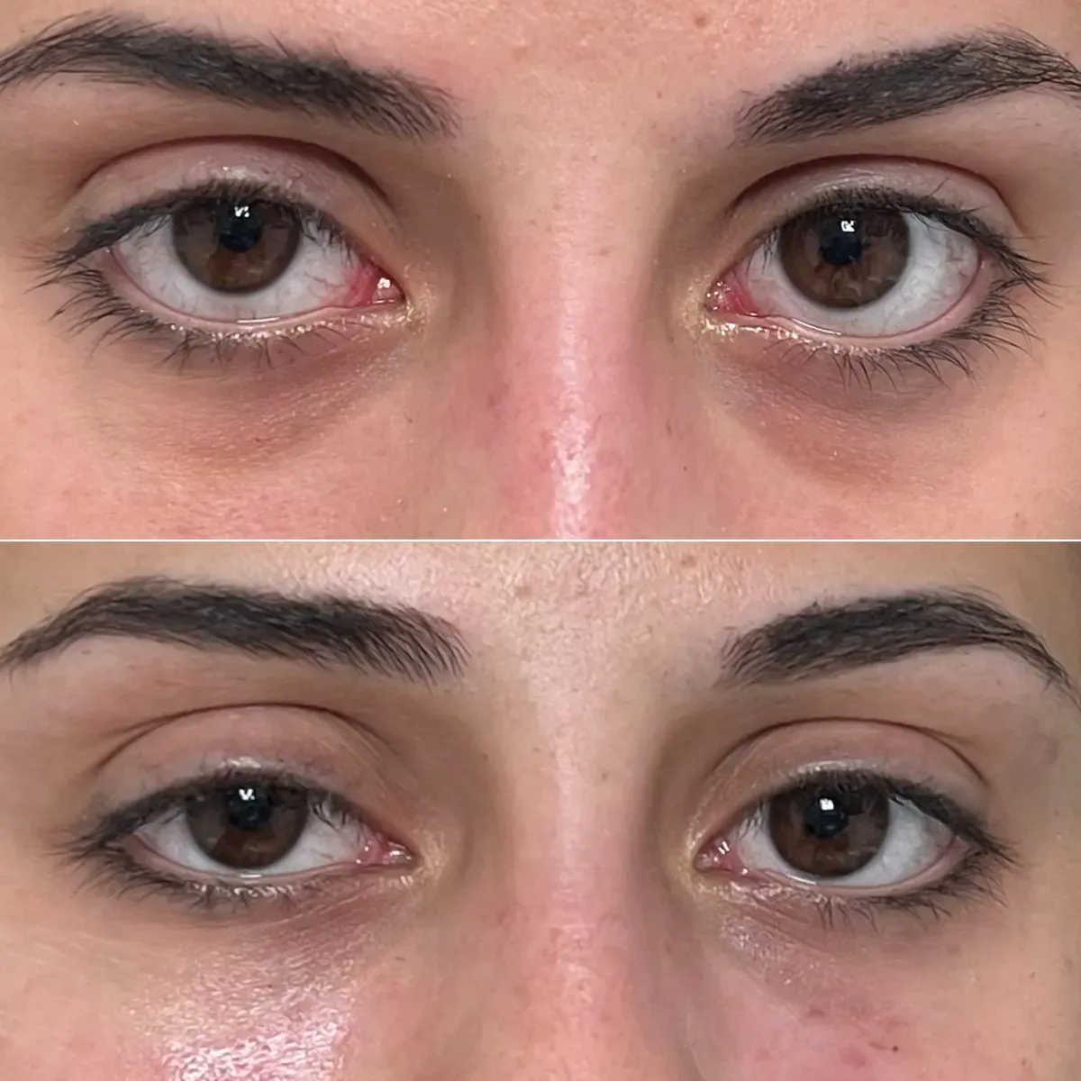 Hijaluronski fileri - prije i poslije