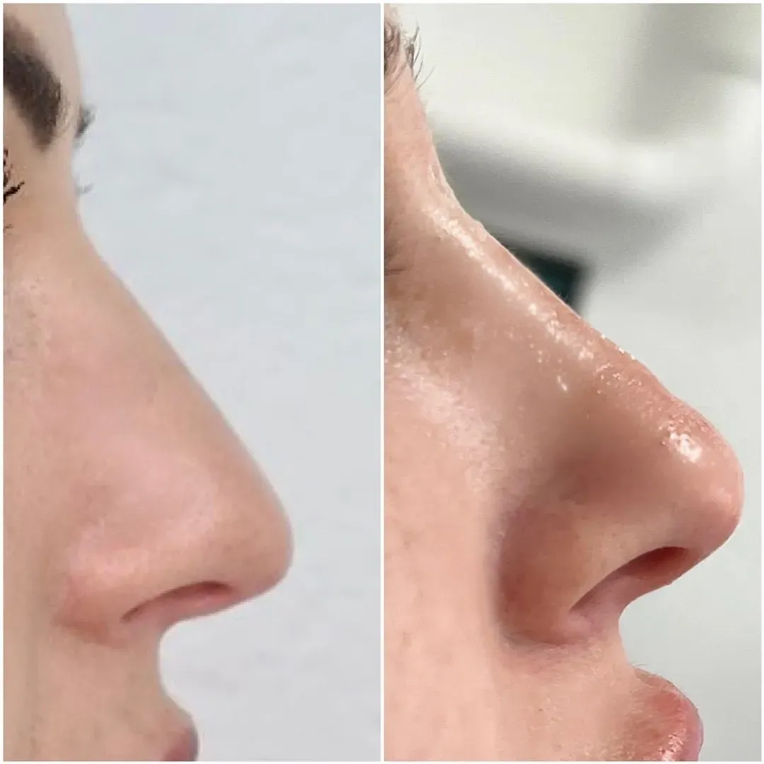 Hijaluronski fileri - prije i poslije