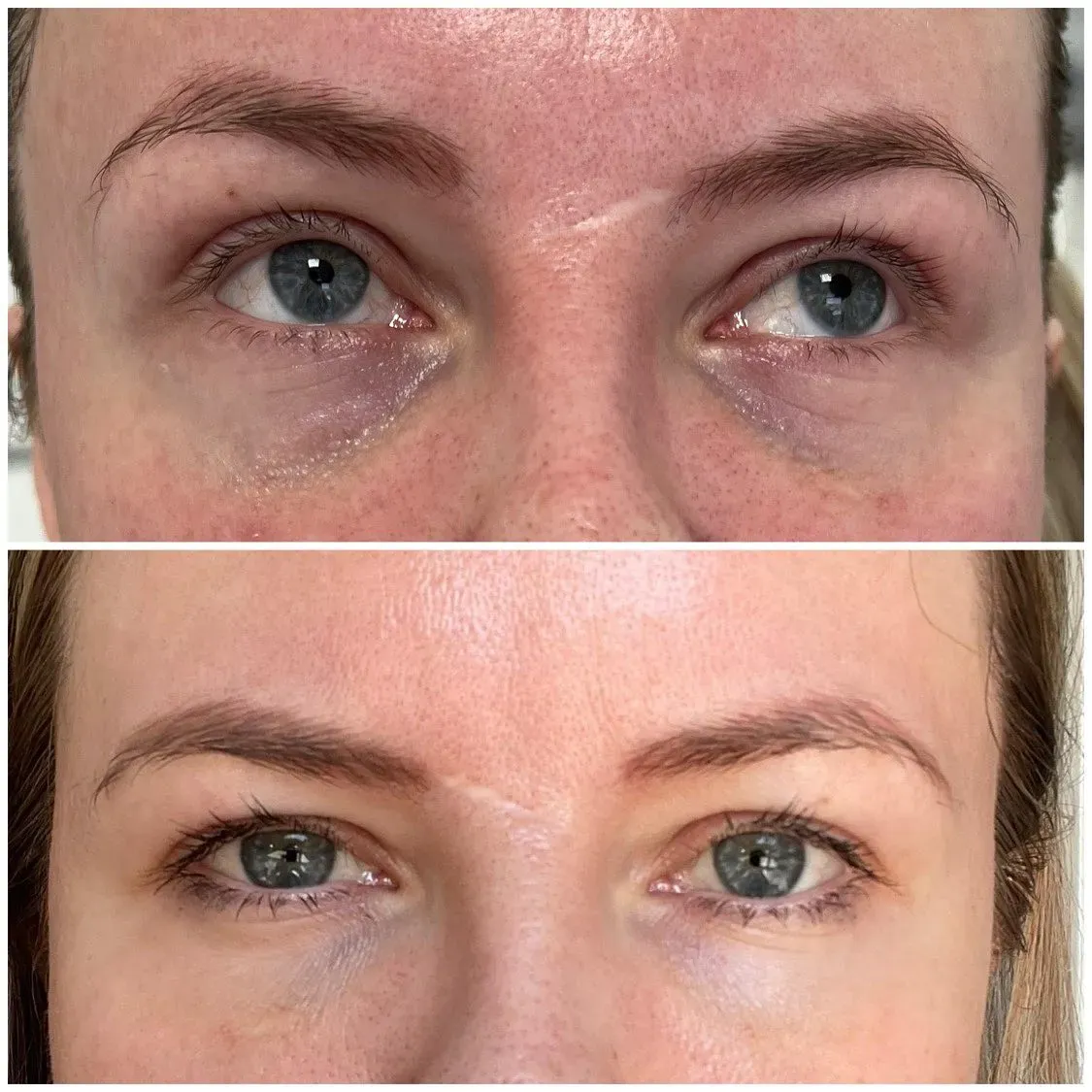 Hijaluronski fileri - prije i poslije