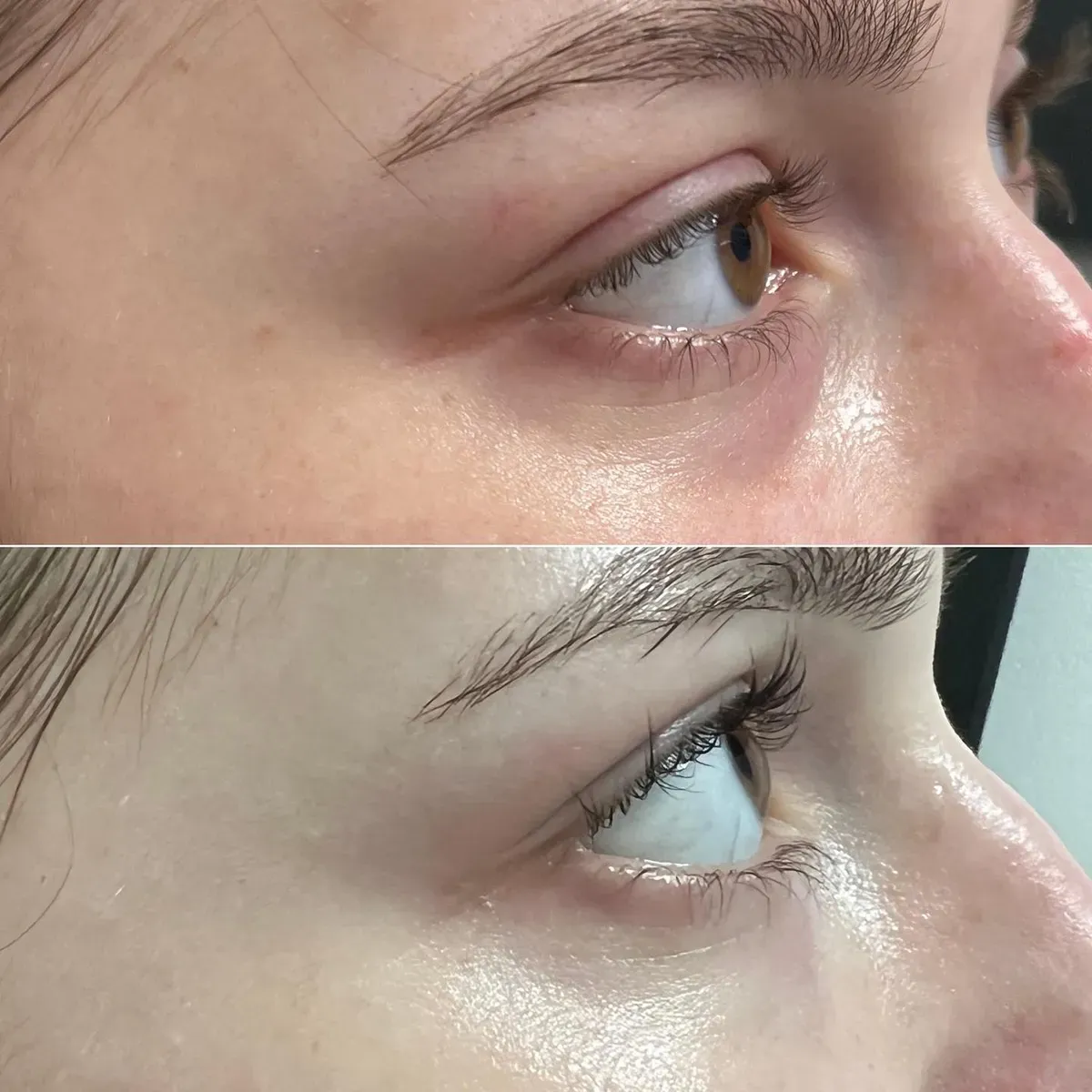 Hijaluronski fileri - prije i poslije