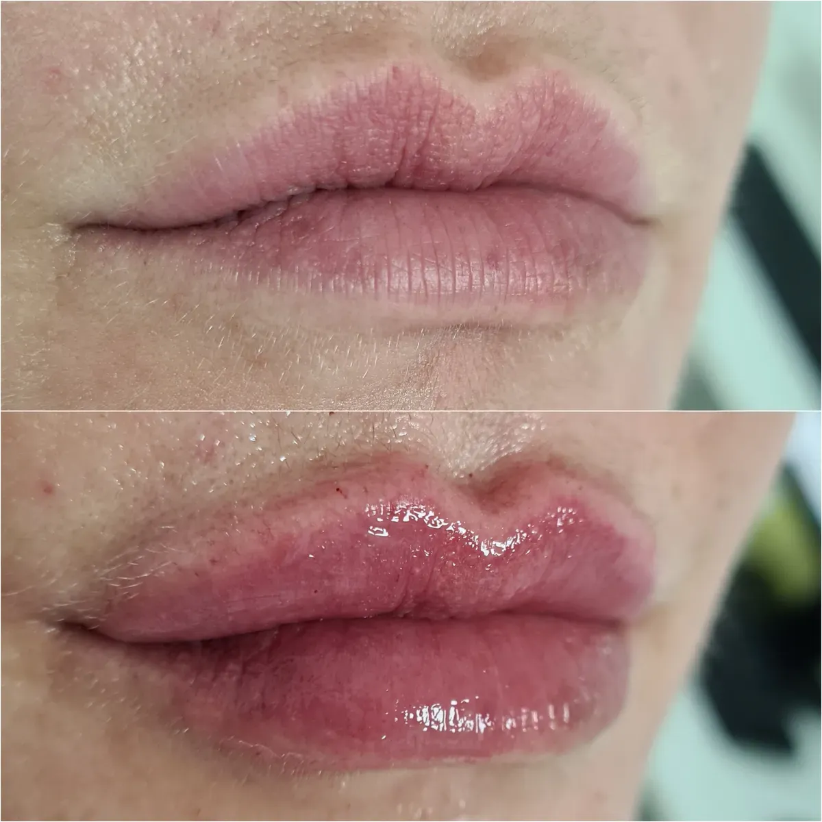 Oblikovanje usana - prije i poslije