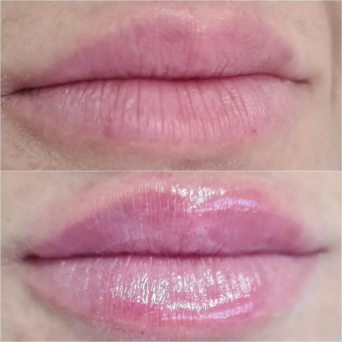 Oblikovanje usana - prije i poslije