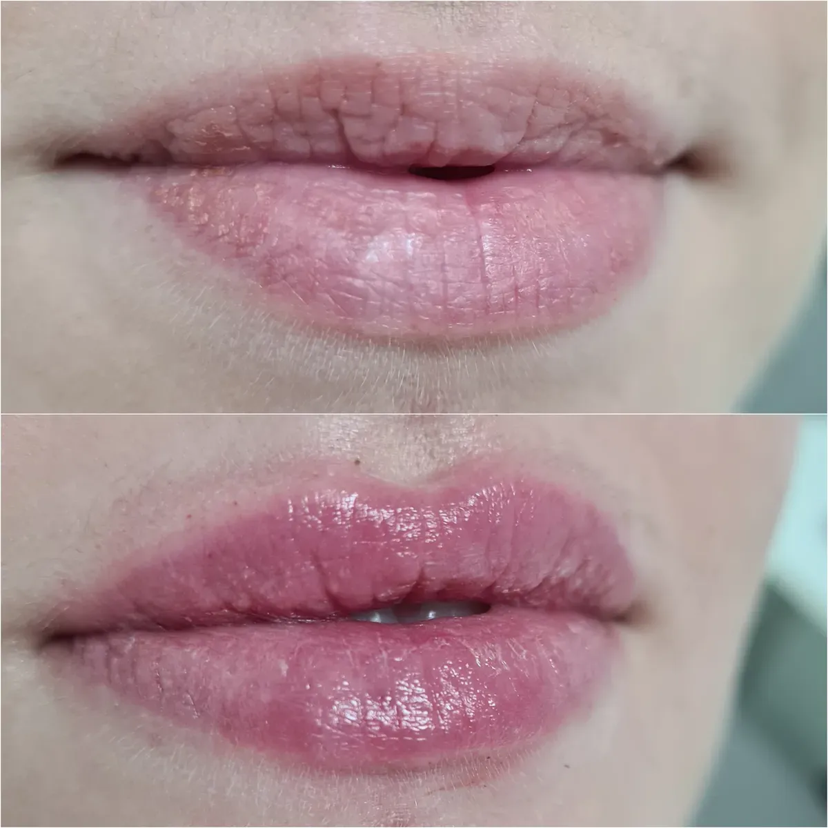 Oblikovanje usana - prije i poslije