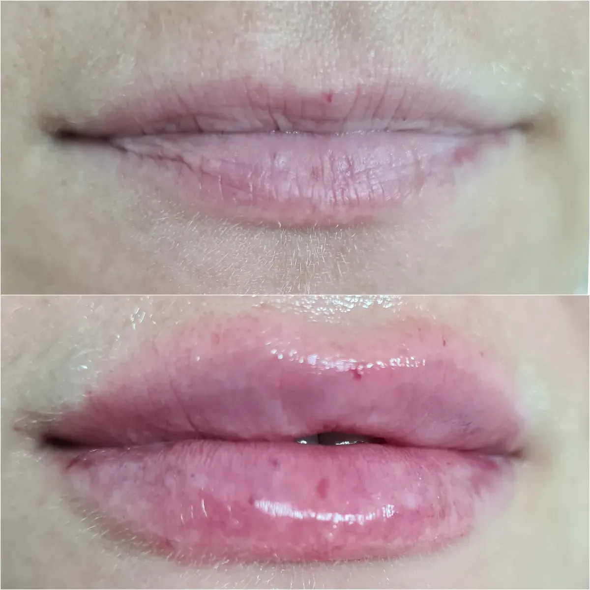 Oblikovanje usana - prije i poslije