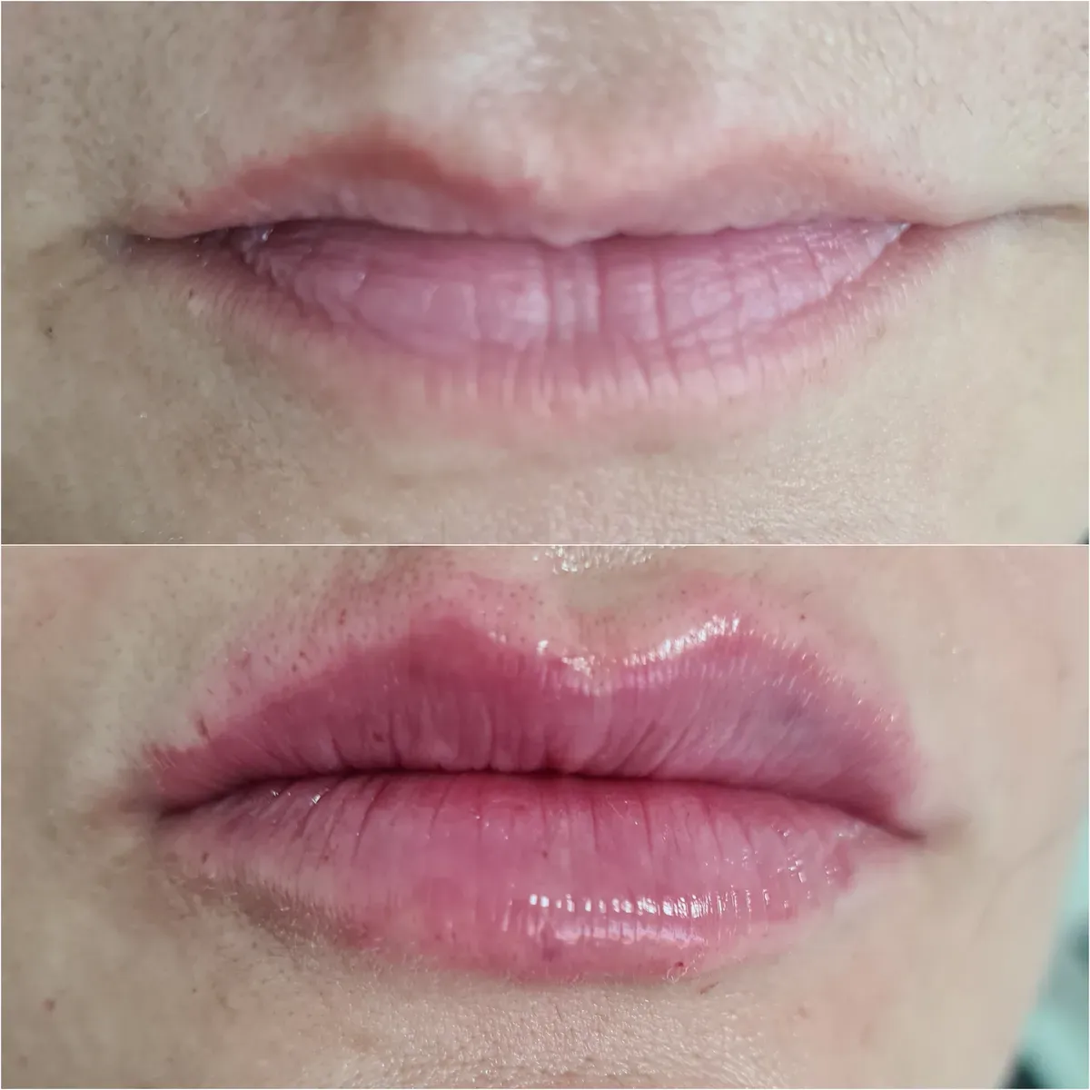 Oblikovanje usana - prije i poslije