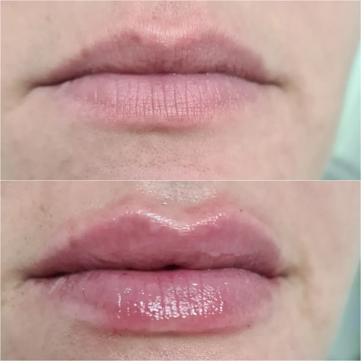 Oblikovanje usana - prije i poslije