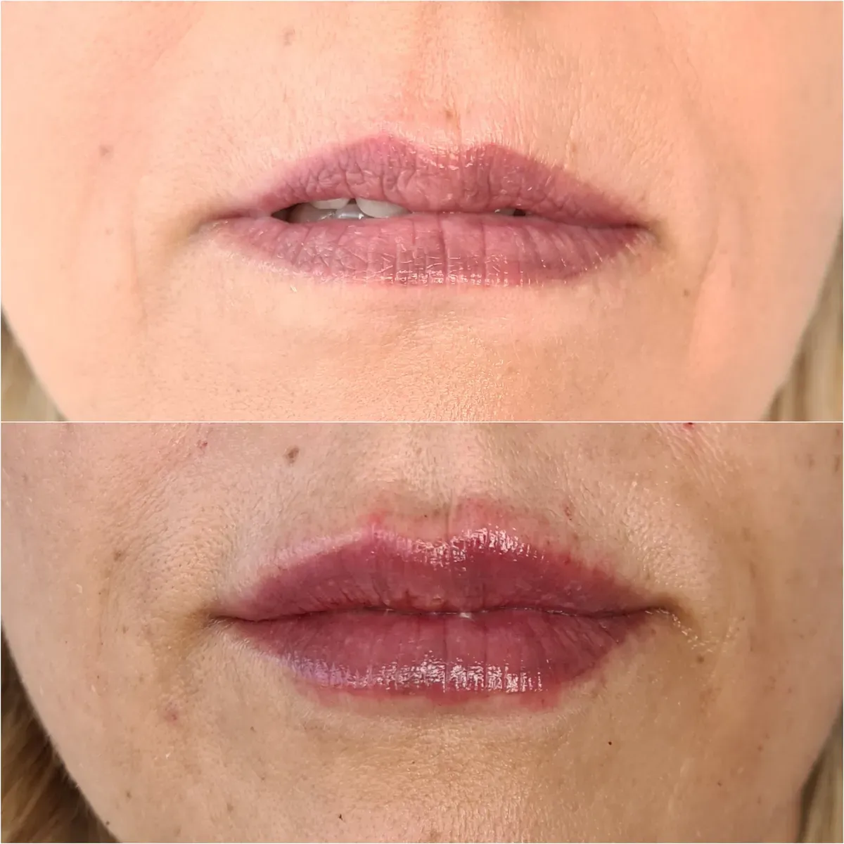 Oblikovanje usana - prije i poslije