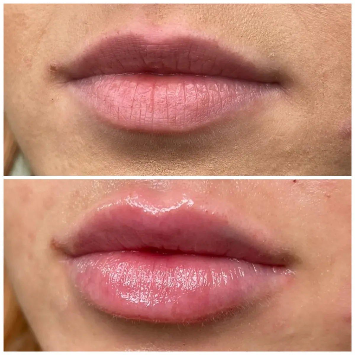 Oblikovanje usana - prije i poslije