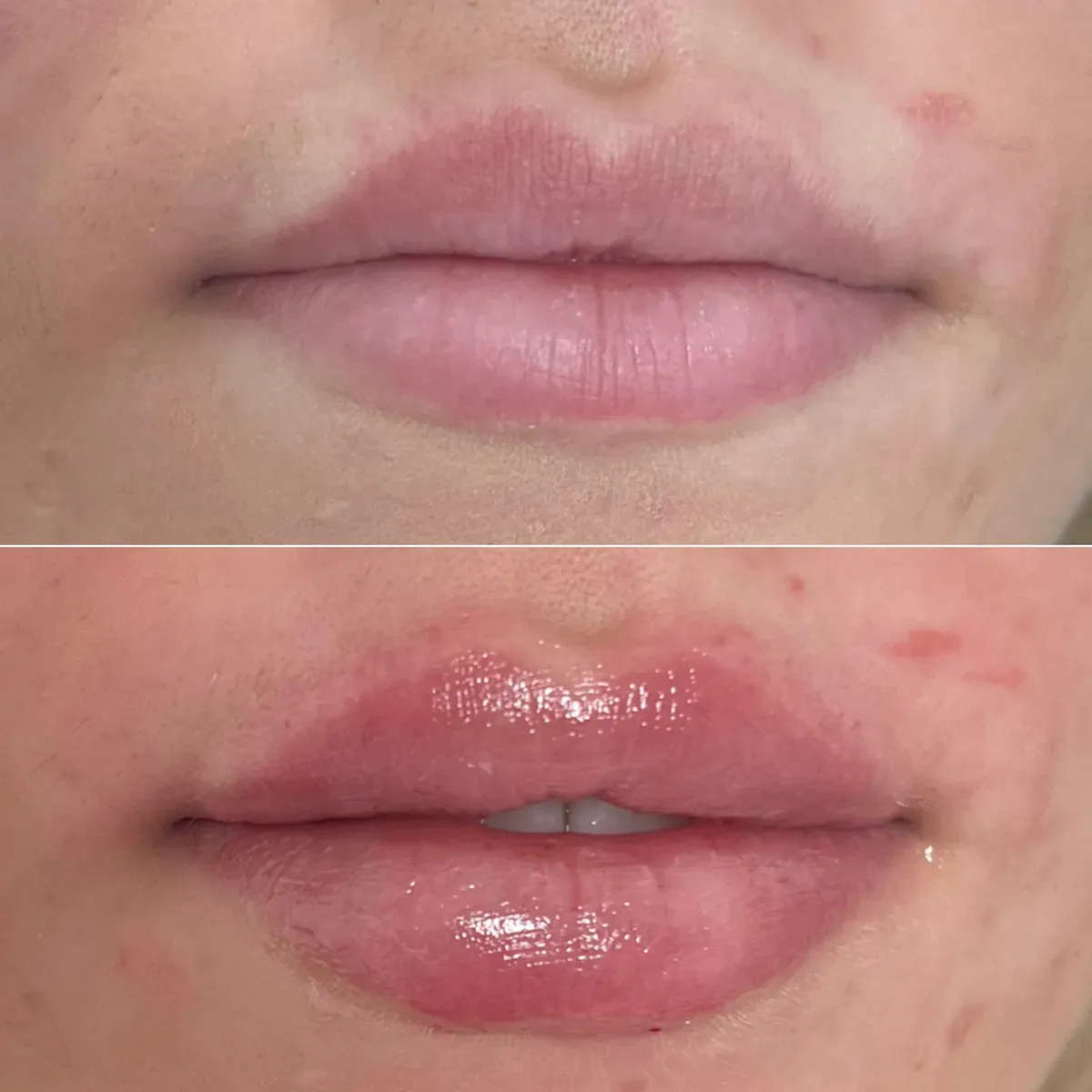 Oblikovanje usana - prije i poslije