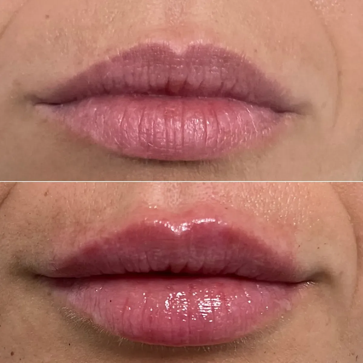 Oblikovanje usana - prije i poslije