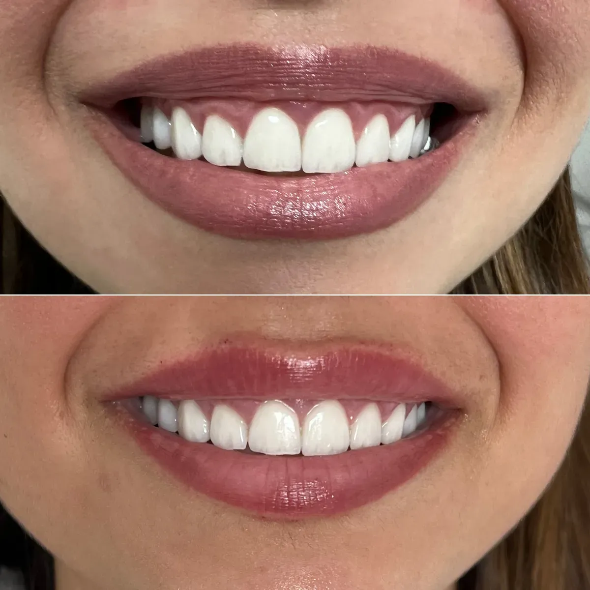 Oblikovanje usana - prije i poslije