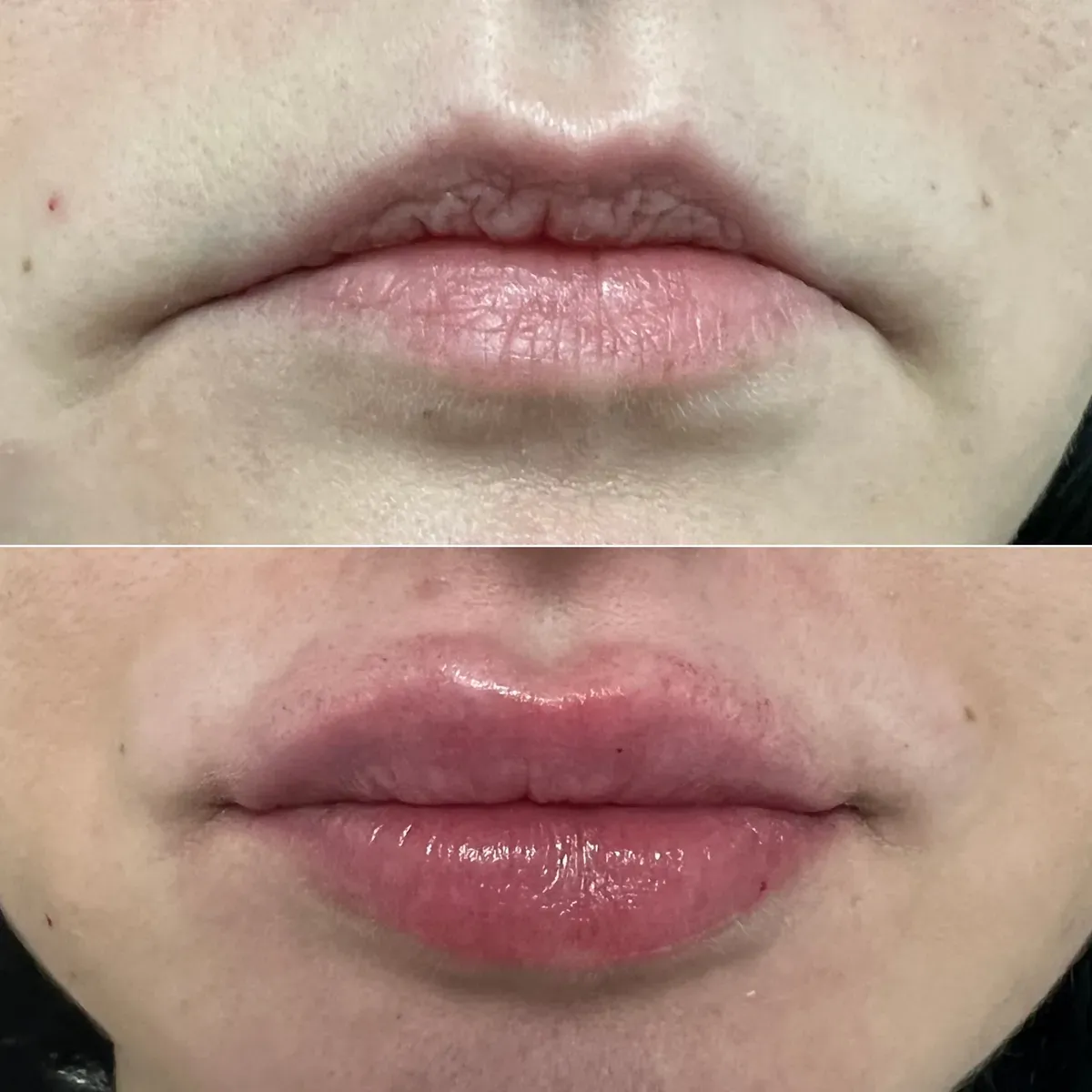 Oblikovanje usana - prije i poslije