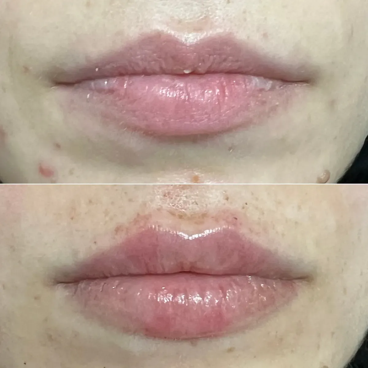 Oblikovanje usana - prije i poslije