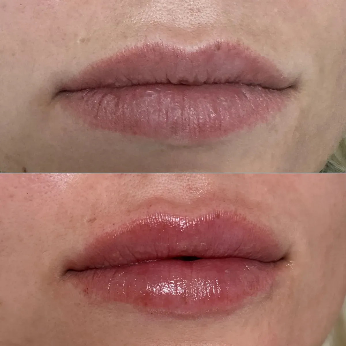 Oblikovanje usana - prije i poslije