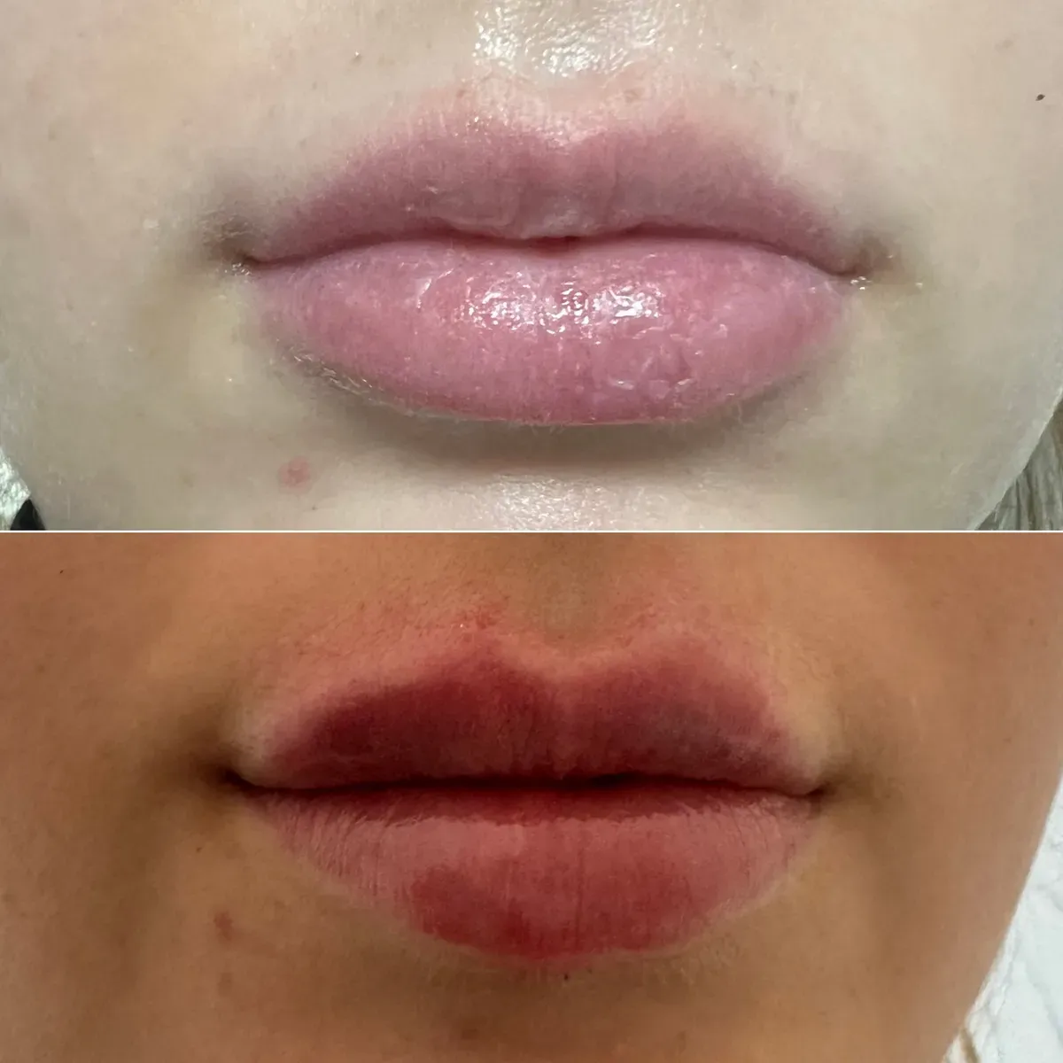 Oblikovanje usana - prije i poslije