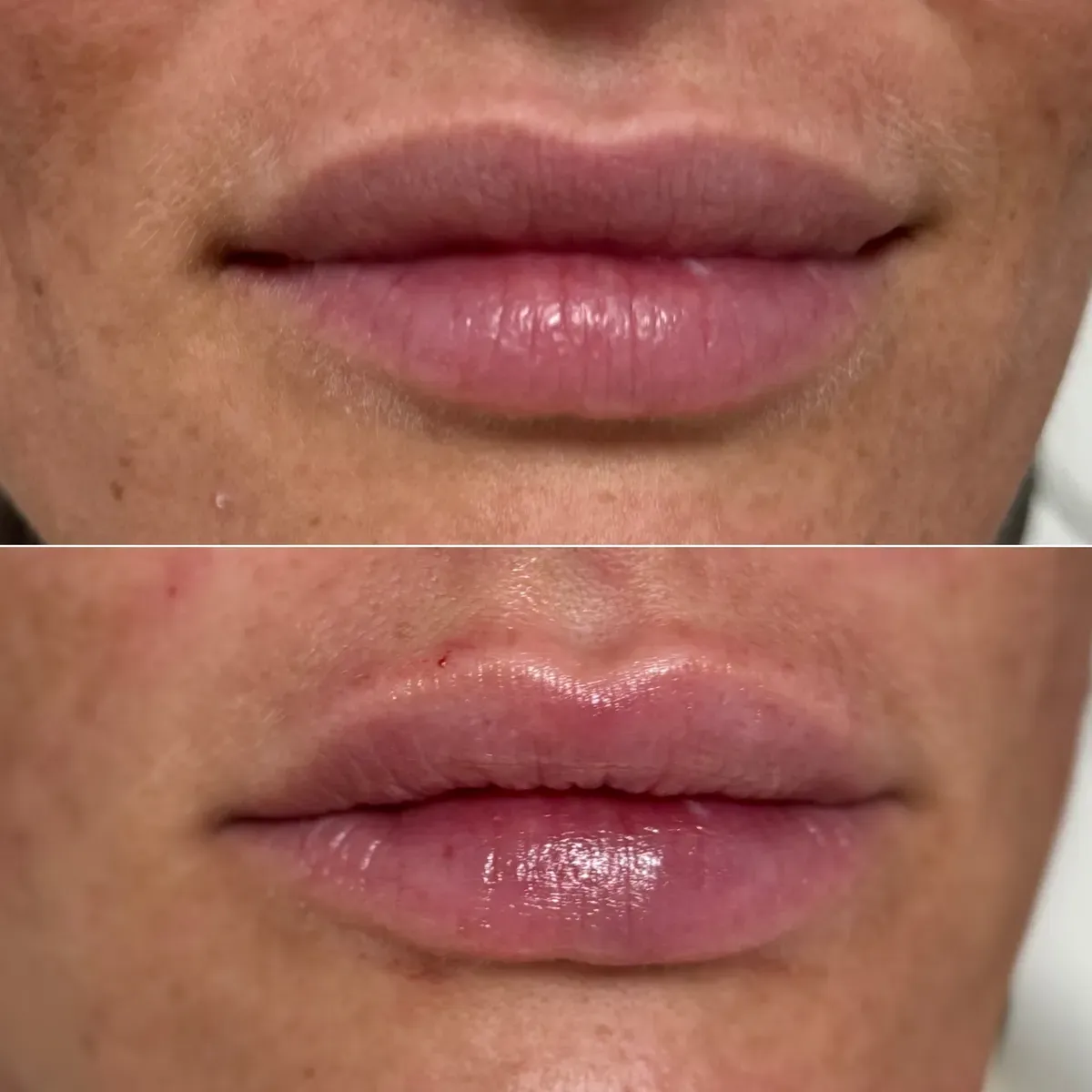 Oblikovanje usana - prije i poslije