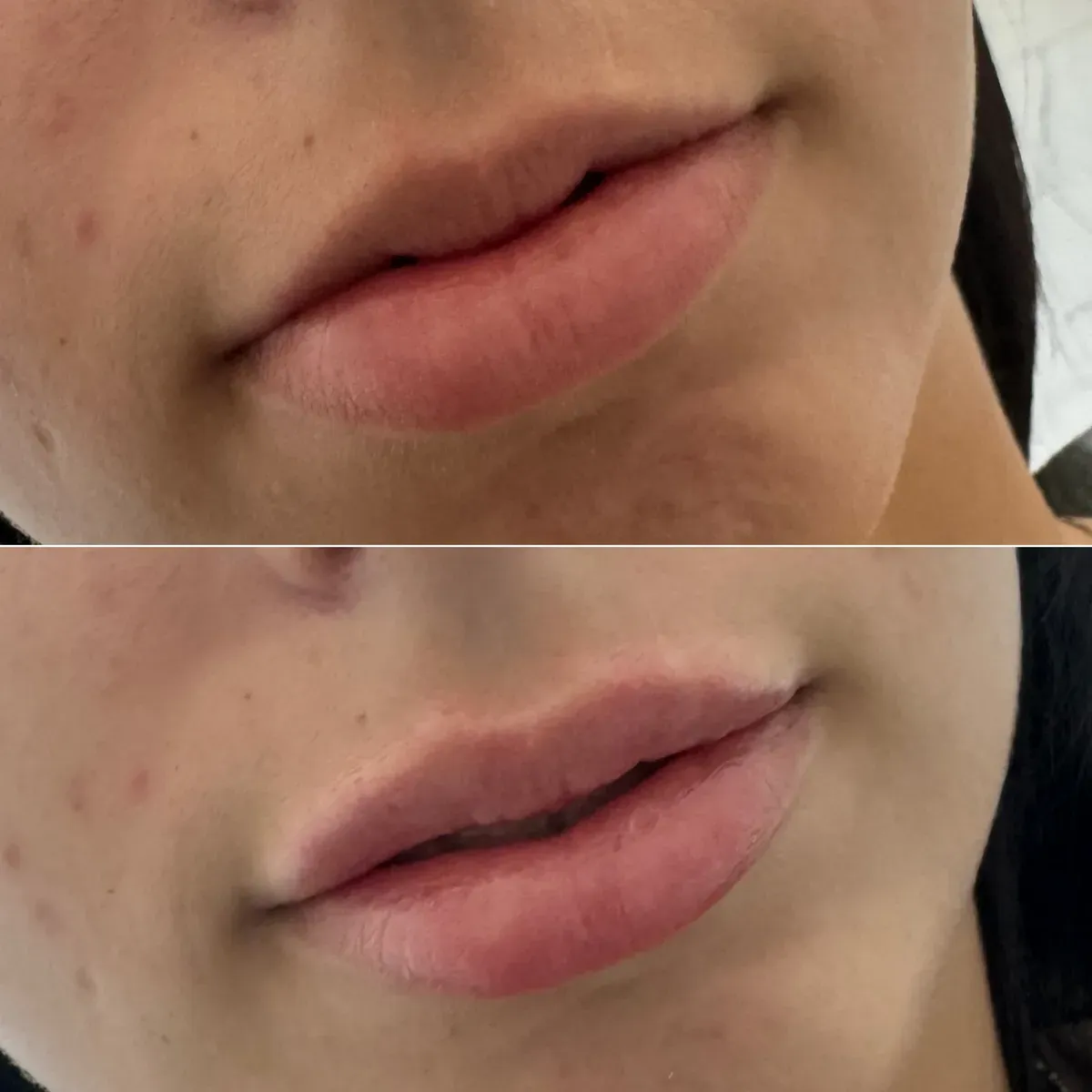 Oblikovanje usana - prije i poslije