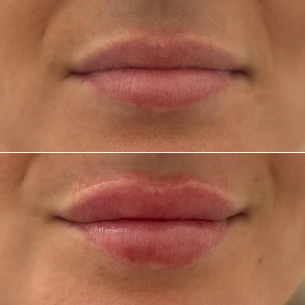 Oblikovanje usana - prije i poslije