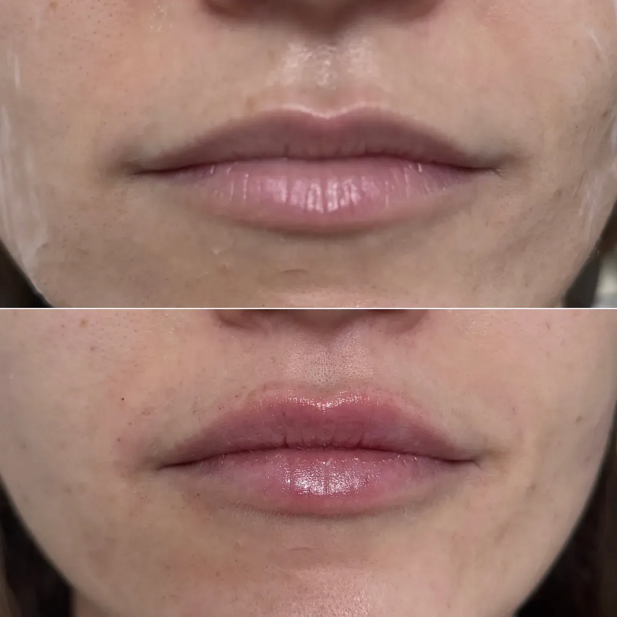 Oblikovanje usana - prije i poslije