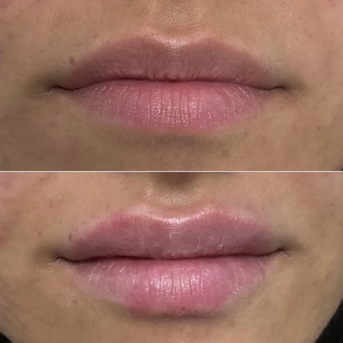 Oblikovanje usana - prije i poslije