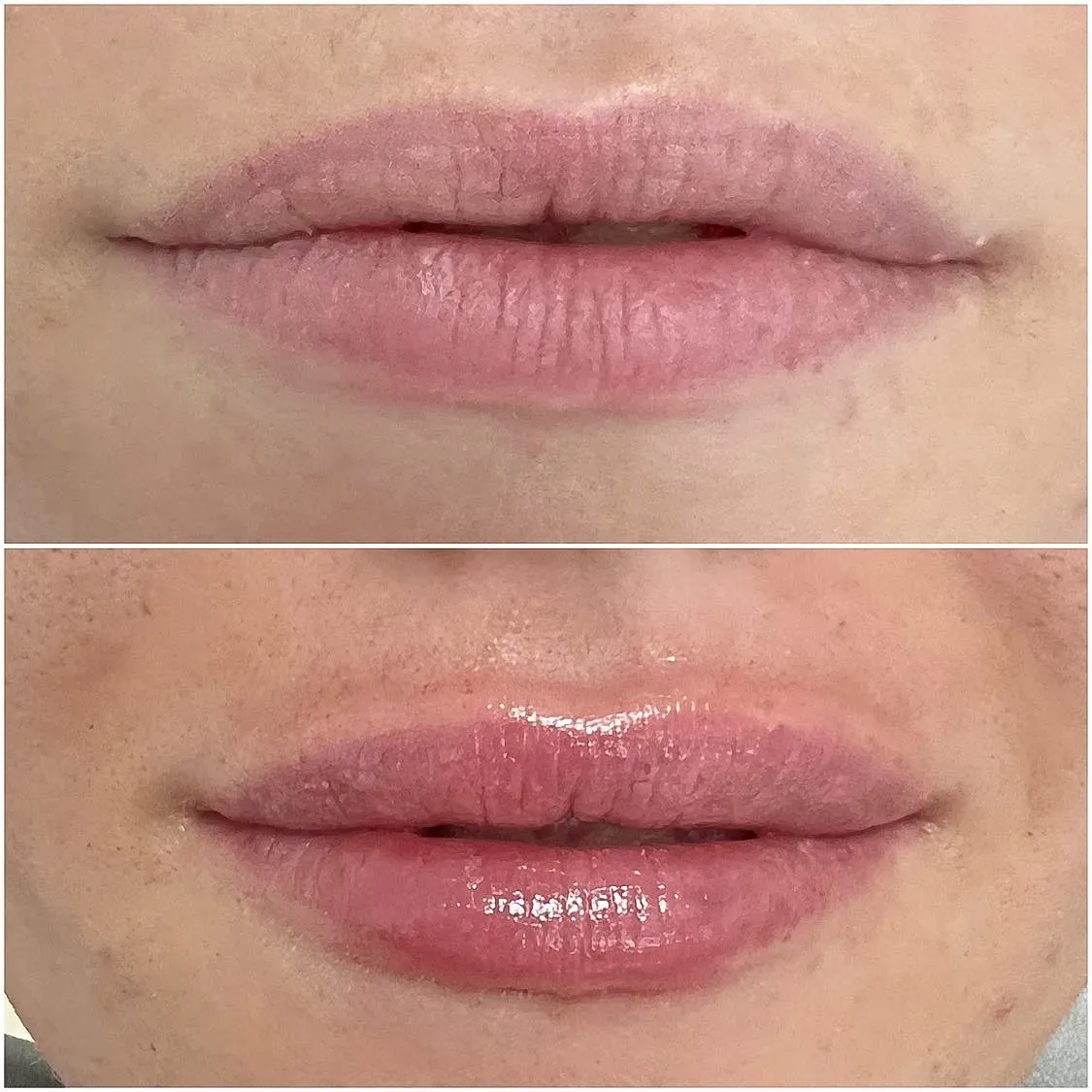 Oblikovanje usana - prije i poslije