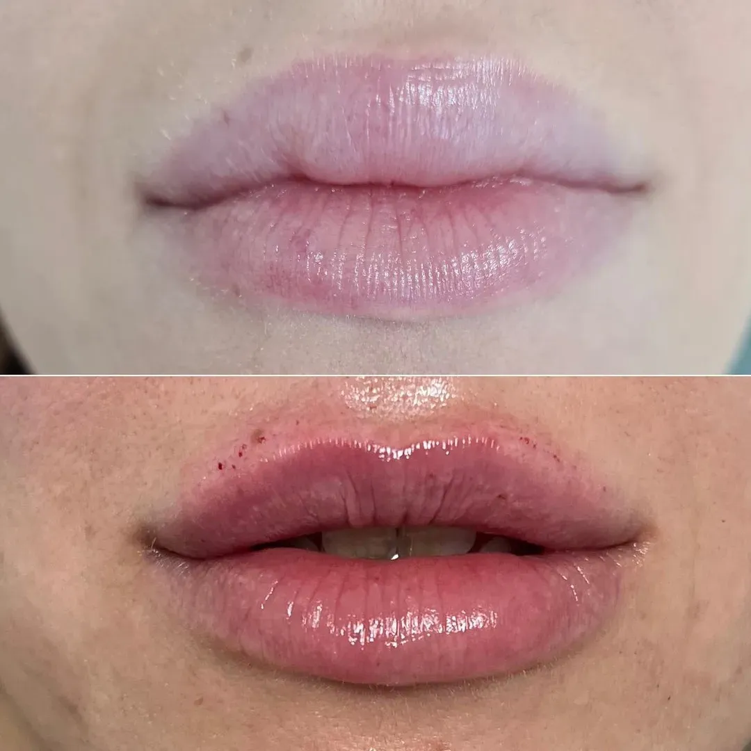 Oblikovanje usana - prije i poslije