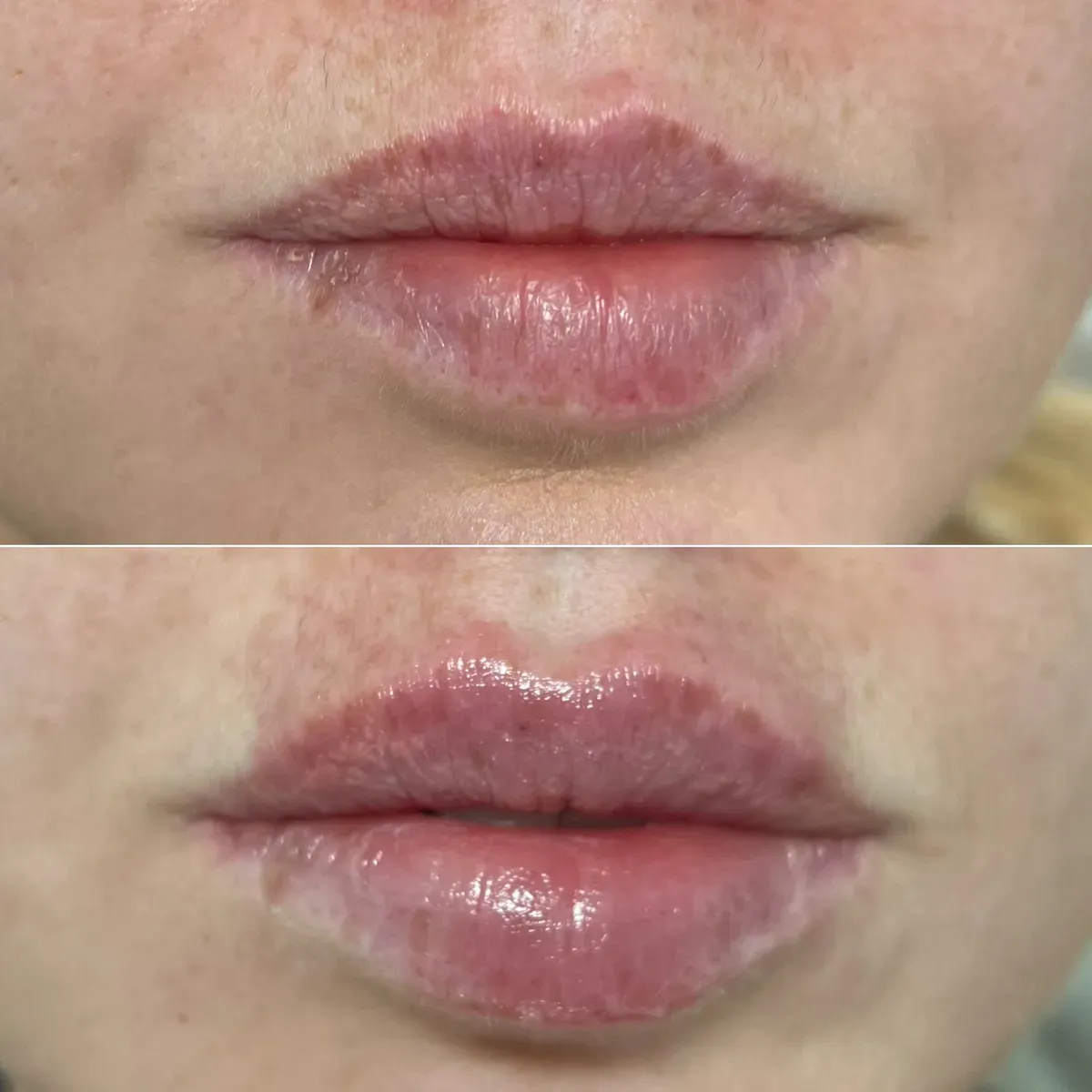 Oblikovanje usana - prije i poslije